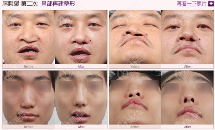 before and after cleft lip repair by MVP Plastic Surgery