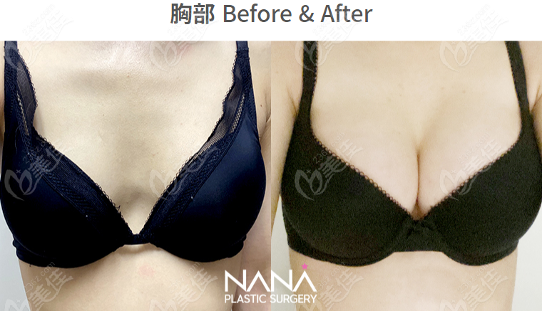 How is NANA Plastic Surgery's breast augmentation?