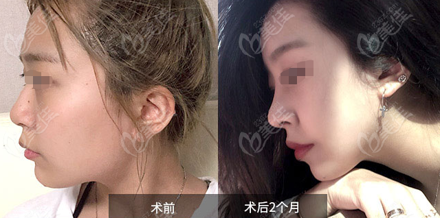 Jin Sang-hyun's rhinoplasty