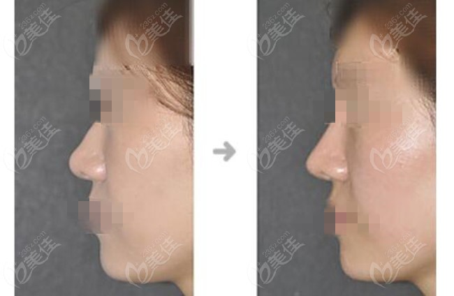 Nose Repair Surgery