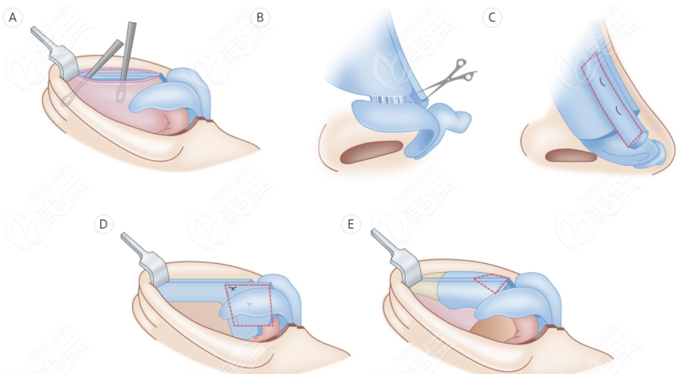  nasal reconstruction