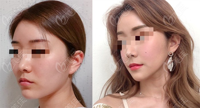 Cheekbone Surgery at TS Plastic Surgery