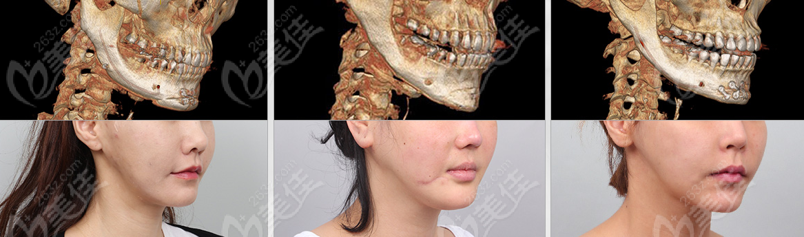 DA Plastic Surgery's bone grinding style