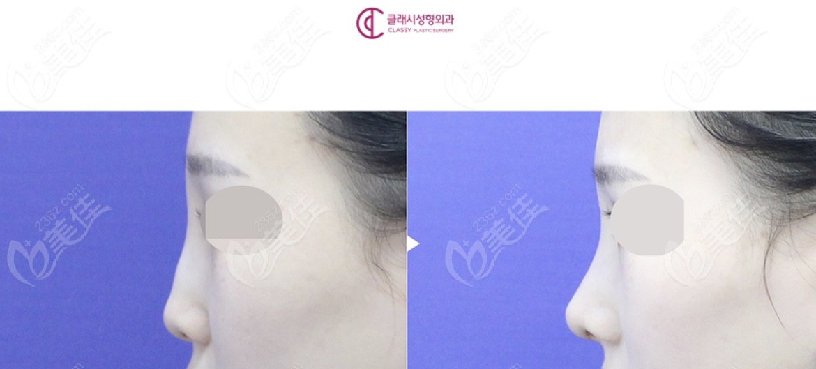 flat nose with a low nasal bridge