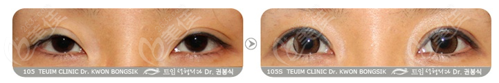 double eyelid repair 