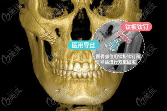 cheekbone surgery