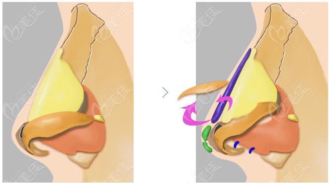 advantages of rhinoplasty