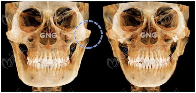 minimal bone sutures in cheekbone enhancement