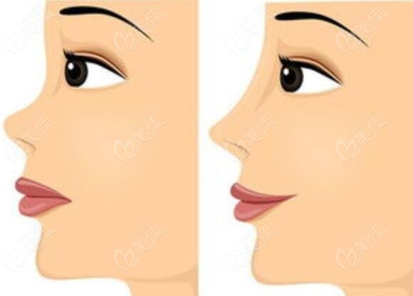 nose reconstruction