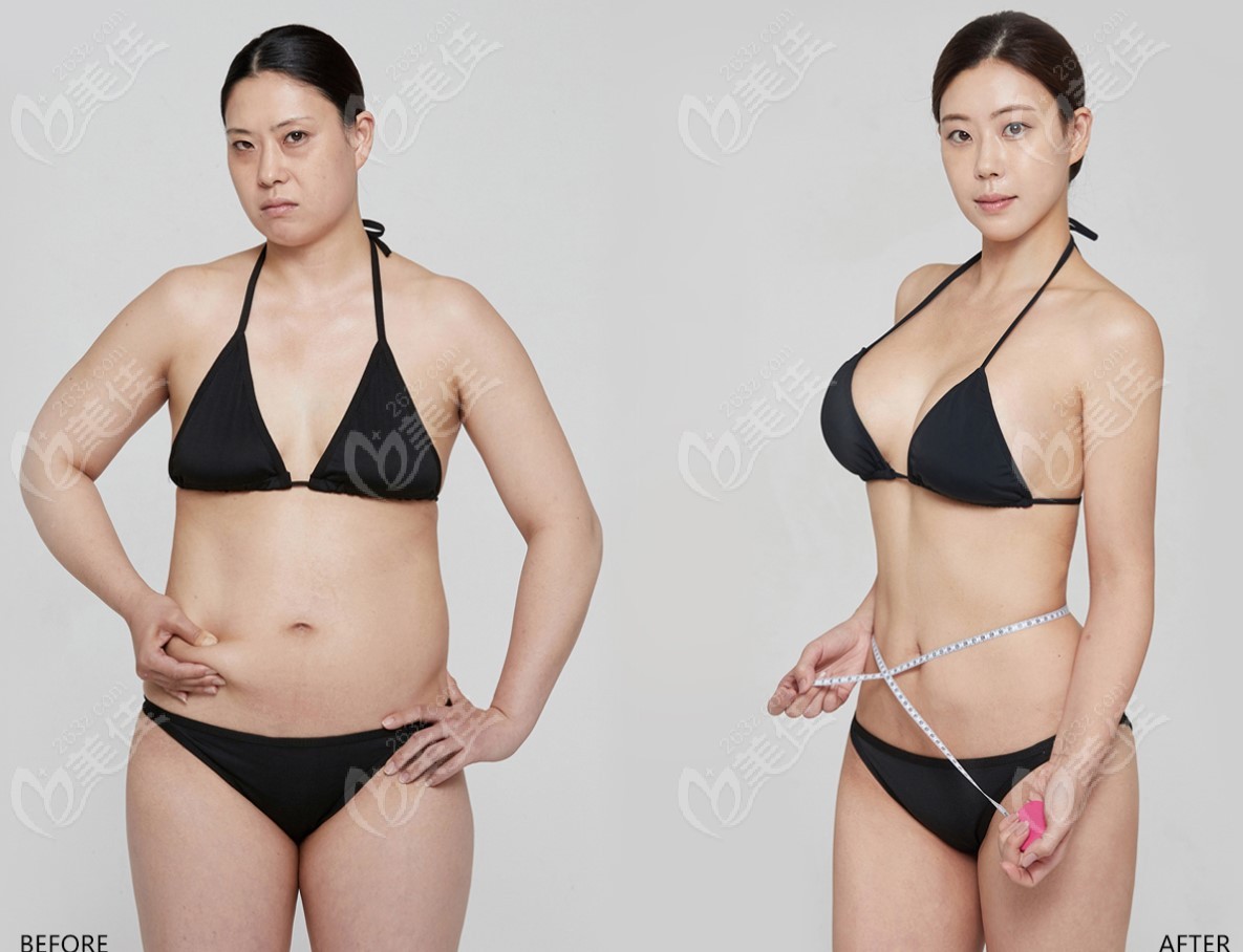 S-Line liposuction