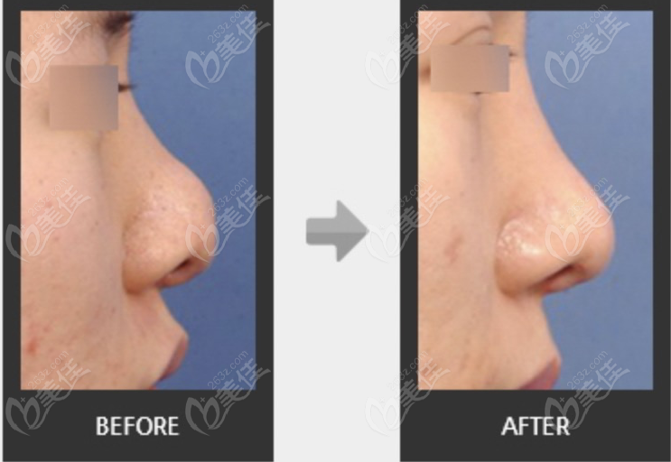 nose reduction