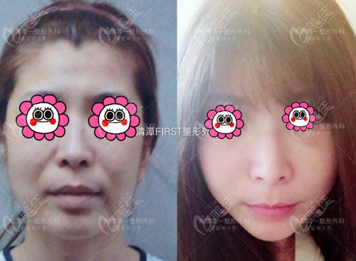 Facelift Procedures at Cheongdam First Plastic Surgery