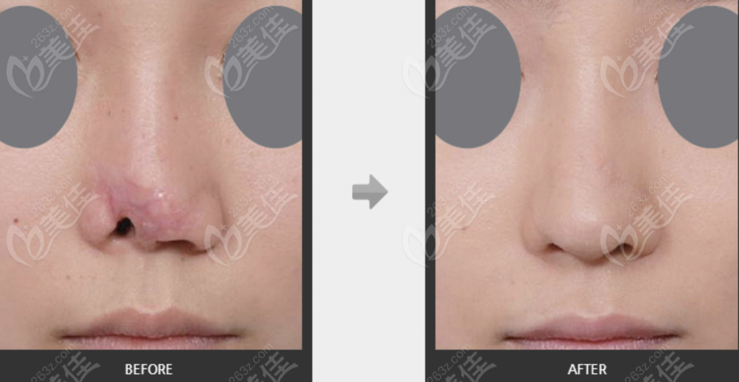 nose tip defect repair