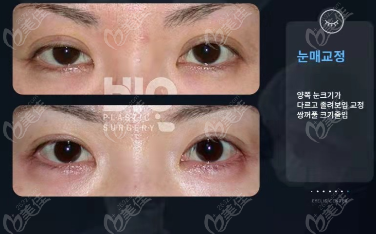 narrowing of wide double eyelids repair