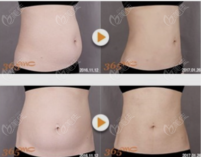 abdomen liposuction example