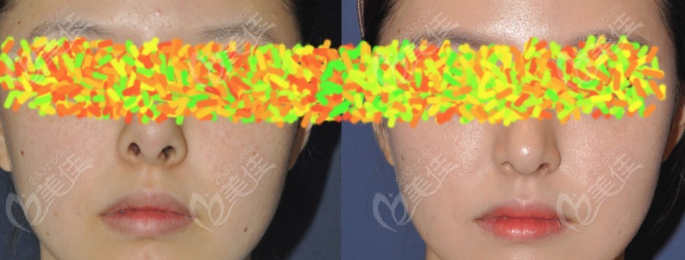 Case of Inflammatory Nasal Deformity