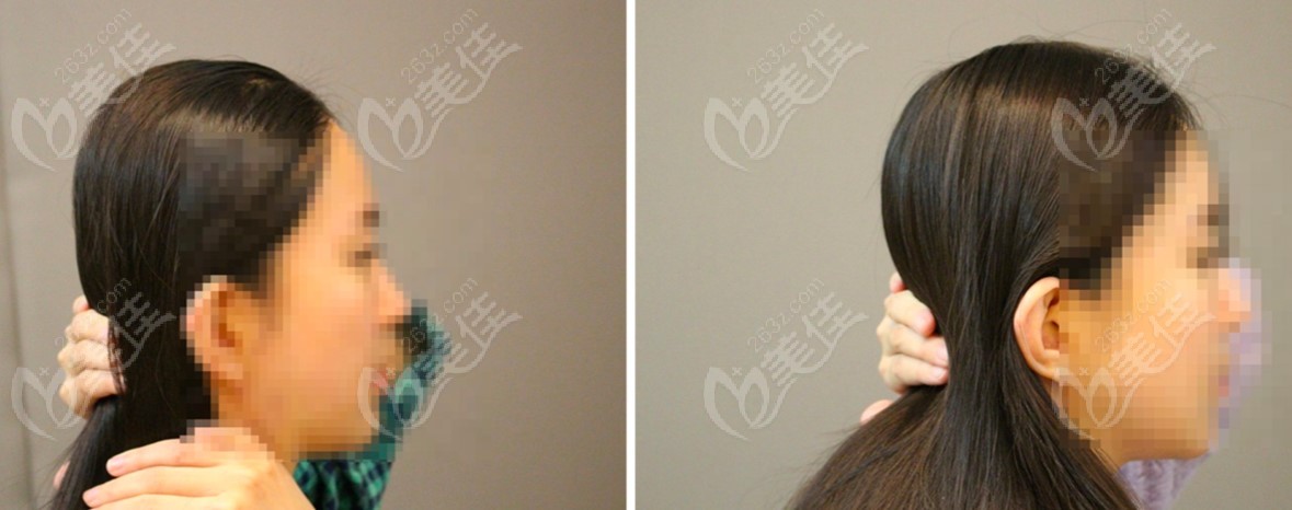Before and after photos of posterior skull augmentation