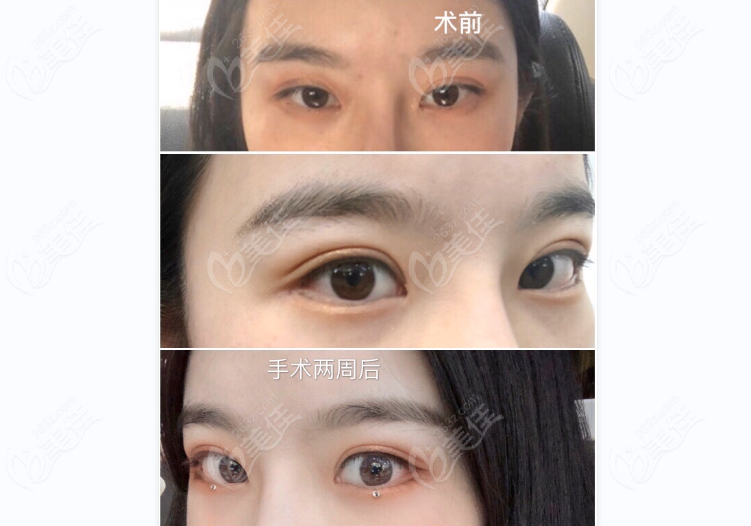 double eyelid repair at Pure Plastic Surgery