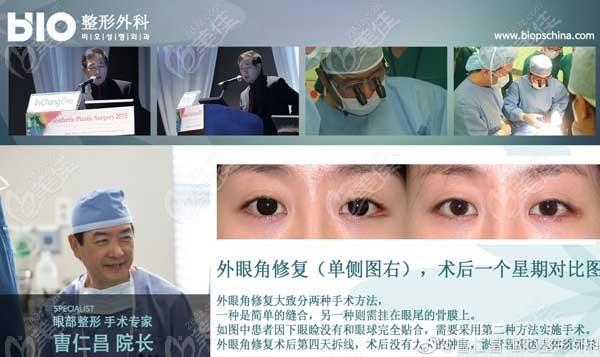 Cases of Cao Renchang's external eye corner repair