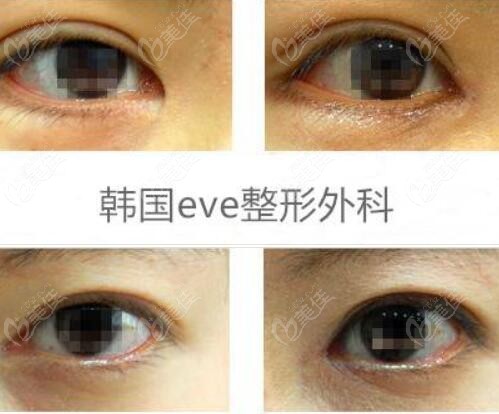 Eve Plastic Surgery's Eye Repair