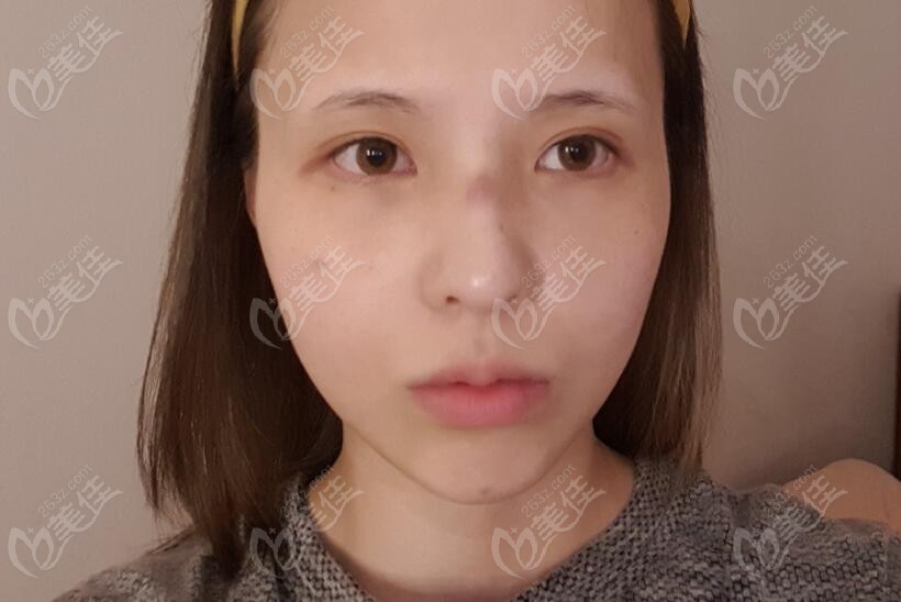 Comparison of before and after contour surgery images