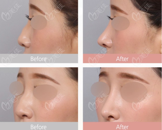 Dr. Ren Mingmin's Before and After Comparison at VG Plastic Surgery