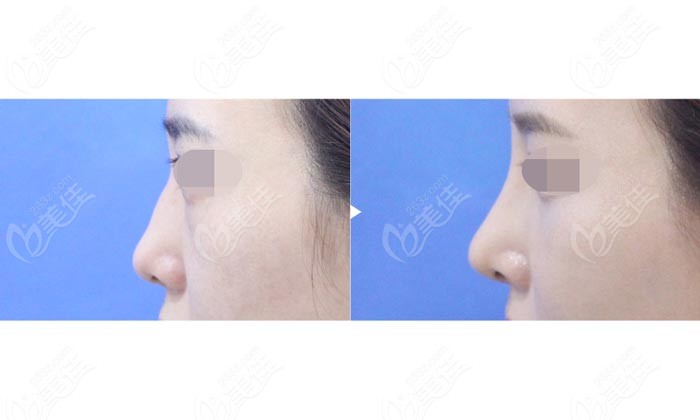 hooked nose correction