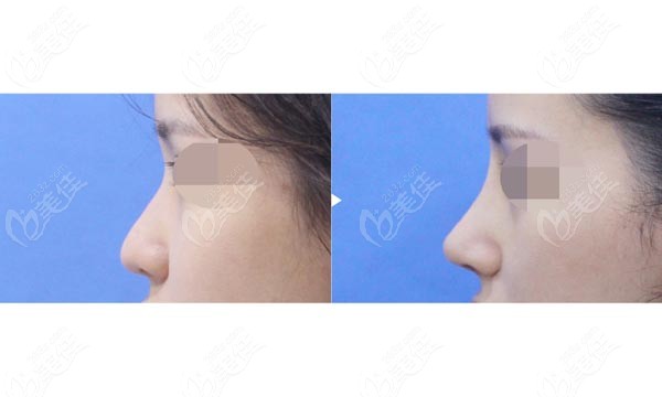 example photos for low nose reshaping