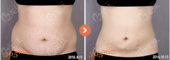 Abdominal liposuction case study at 365mc