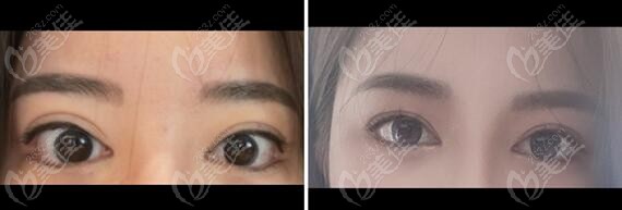  comparison photos of double eyelid repair surgeries