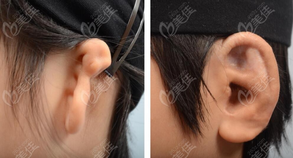 Ear Reconstruction Techniques