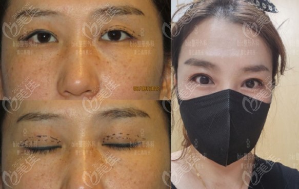 Examples of Cho Jae-chang's double eyelid repair surgery