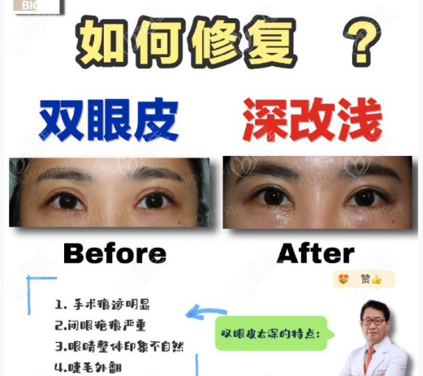 transforming deep double eyelids into shallow double eyelids
