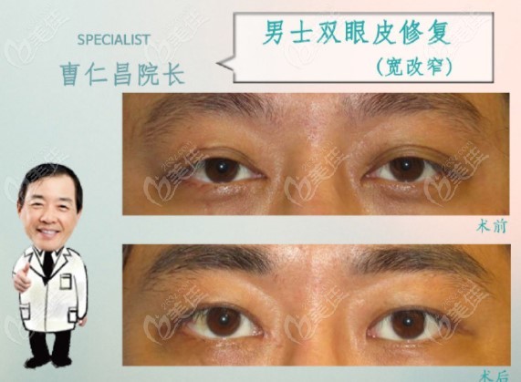 narrowing a wide double eyelid in a male patient