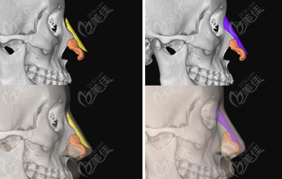 3D printing for nasal reconstruction