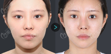 TS Plastic Surgery has good outcomes for cheekbone reduction