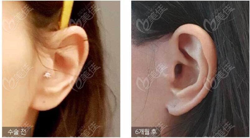 no concern about ear deformities