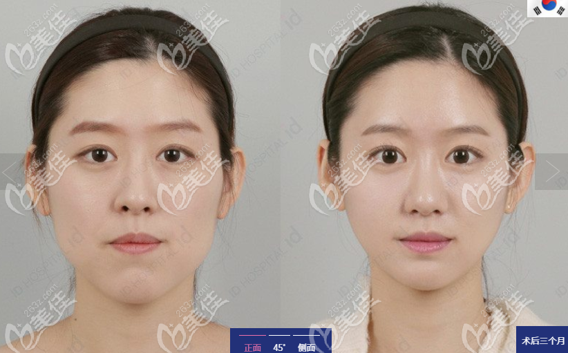 ID Hospital is good at cheekbone contouring techniques