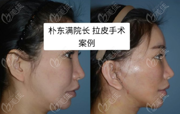 Facelift at Bio Plastic Surgery