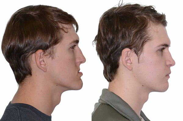 Double Jaw surgery before&after