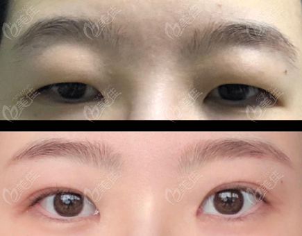 double eyelid surgery