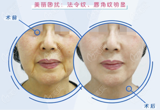 the Results of Facelift Technique