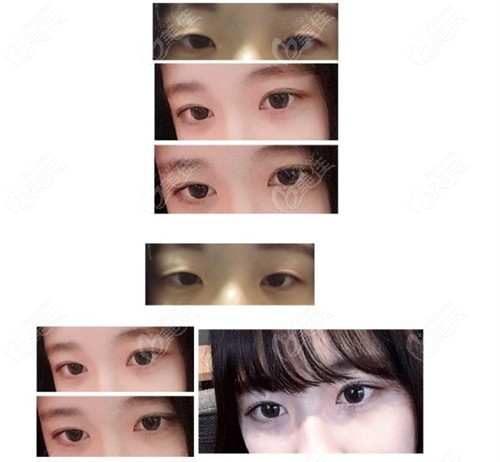 Incisional double eyelid surgery