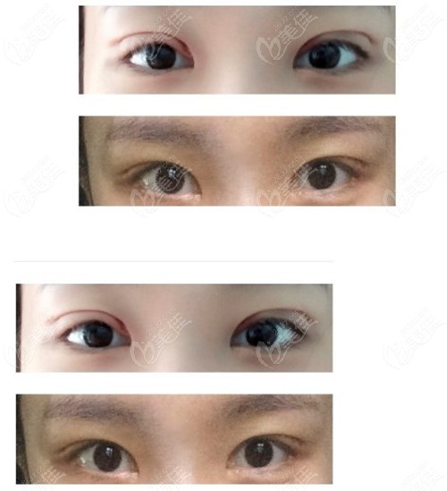 Asymmetrical double eyelid repair