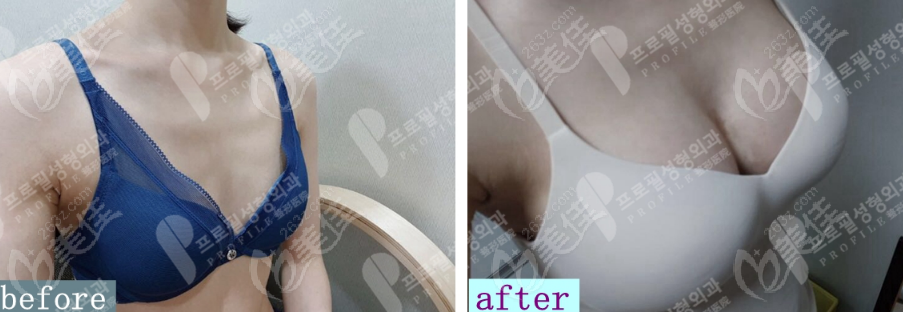 breast augmentation