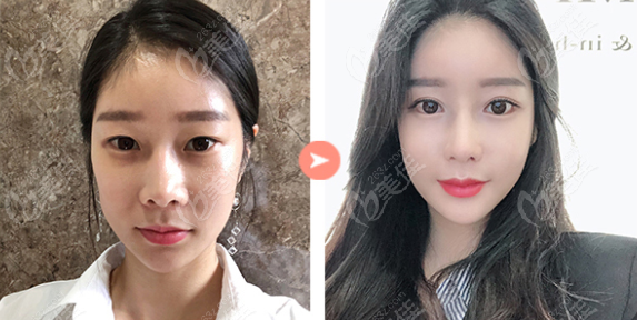 incisional double eyelid surgery