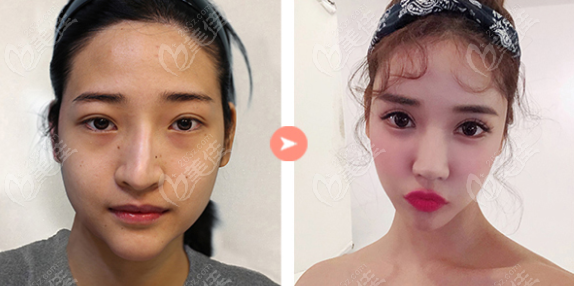 shining partial incisional double eyelid surgery