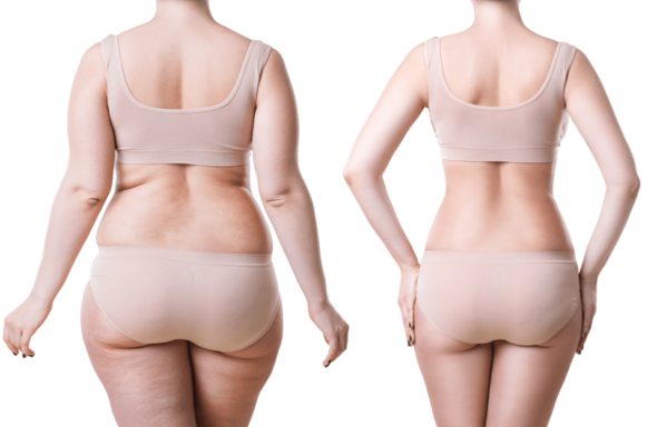 Is liposuction cheaper in South Korea?