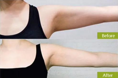 Arm liposuction Korea cost