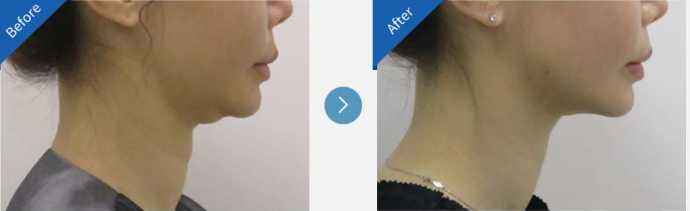 The photos of deep plane facelift before and after in Korea